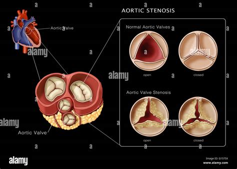 Sténose de la valve aortique